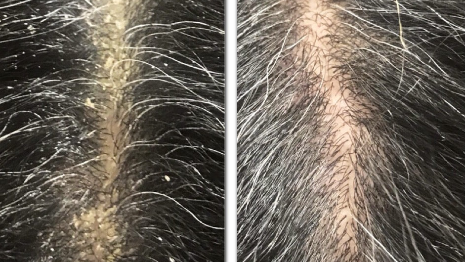 DEEP SCALP TREATMENT